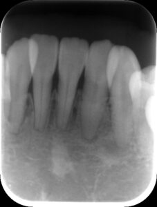 右下側切歯