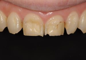 ラミネートべニア(術前)