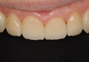 ラミネートべニア術後