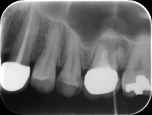 Sinus tractの診査X-ray