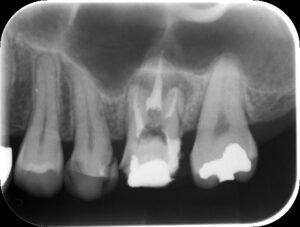 根管充填後X-ray写真